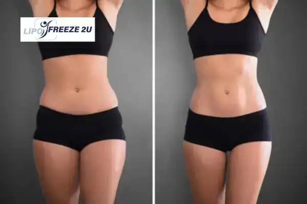 How Can LIPO FREEZE 2U Support Your Post-Pregnancy Body Recovery Tewkesbury?