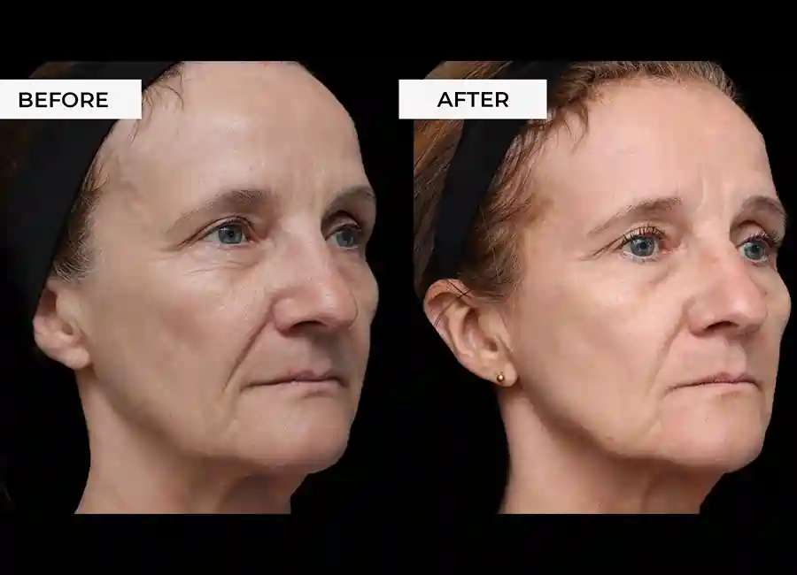 How Many RF Microneedling Sessions Will You Need to See a Difference Tewkesbury?