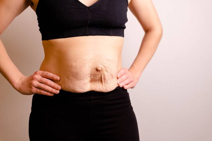 Is Surgery Really the Only Way to Repair Diastasis Recti Tewkesbury?