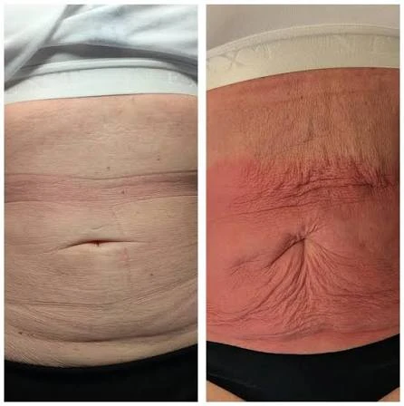 How Does RF Microneedling Improve Crepey, Thin and Uneven Skin Texture Tewkesbury?