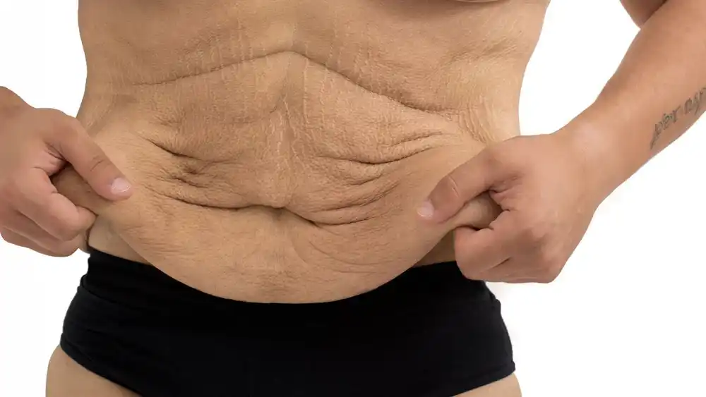 Why Does Weight Loss Medication Leave Some People With Loose or Sagging Skin Tewkesbury?